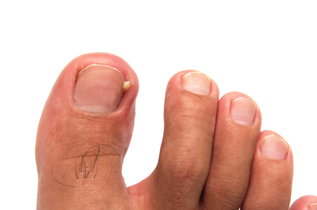 Onychauxis: Definition, Pictures, Symptoms, Treatment, and More