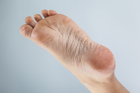 painful callus on heel of foot
