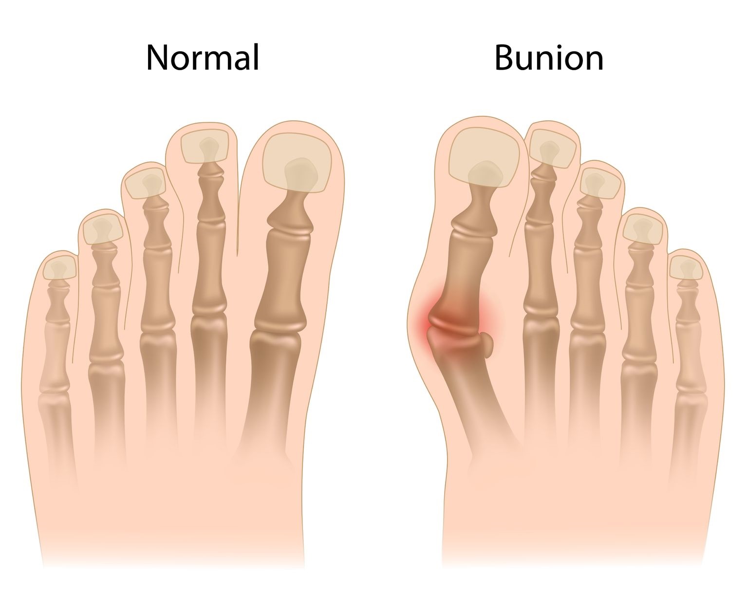 Bunions Cause Toe Problems Syracuse Podiatry Dr. Ryan D'Amico