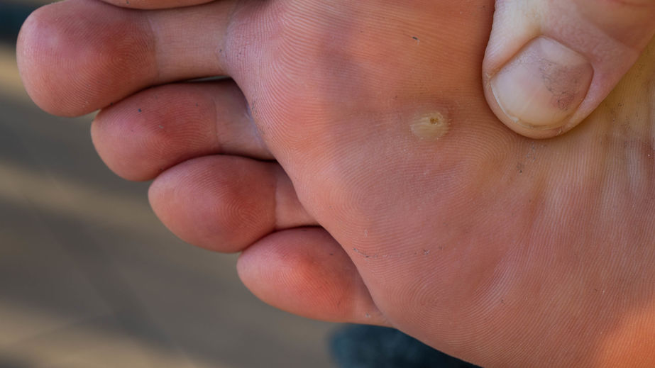 Wart on under foot, Foot fungus traducere în engleză, Wart under foot symptoms