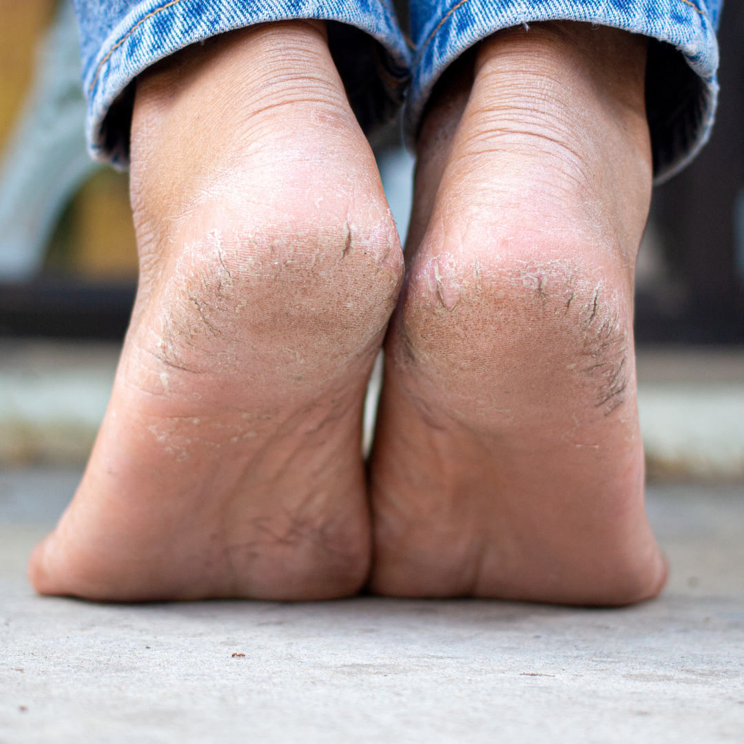 Warning Signs From Your Feet You Shouldn't Ignore