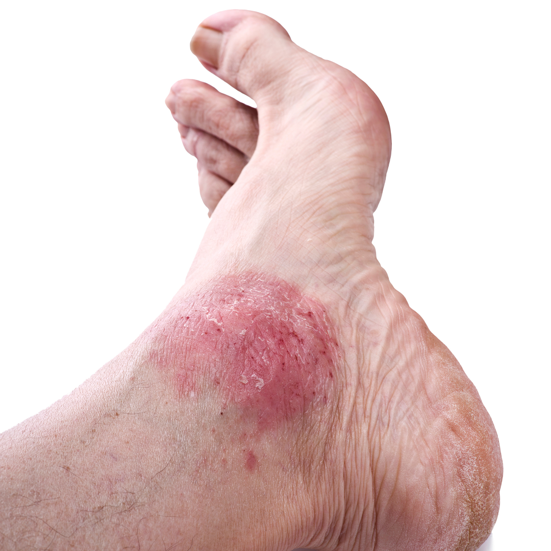 is-your-foot-rash-psoriasis-syracuse-podiatry-dr-ryan-d-amico